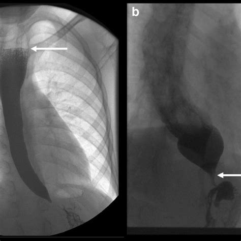 High Resolution Esophageal Manometry With Impedance In A Patient With