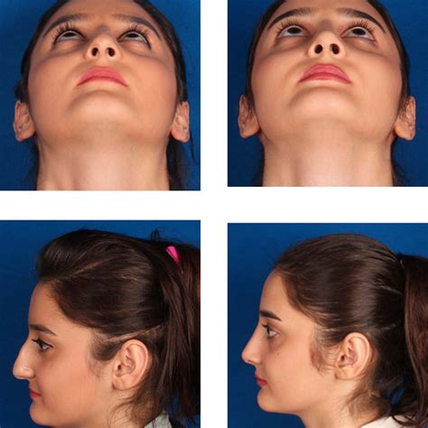 Preoperative Left And Postoperative Right Views Of A Patient With