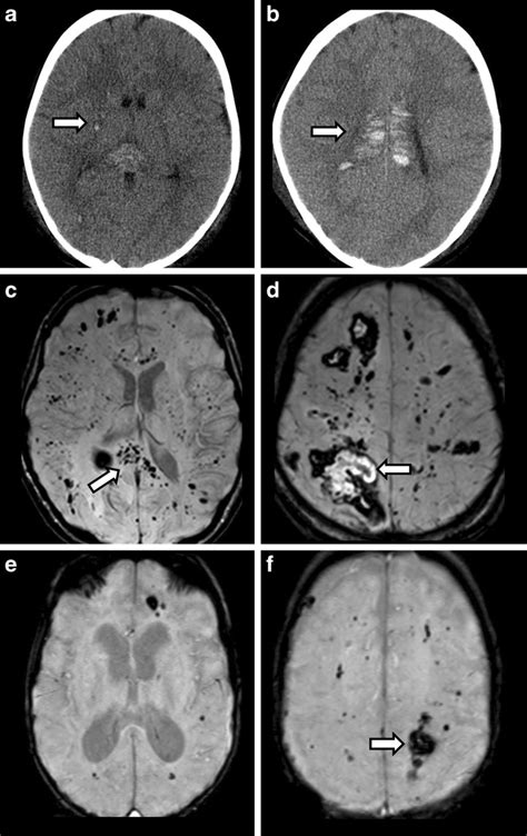 Patients With Intracerebral Hemorrhages The Ct Shows Multiple Acute