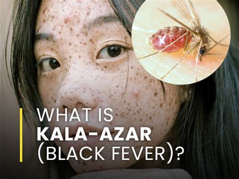 What Is Kala Azar Black Fever Causes Symptoms Risk Factors Treatments And Prevention