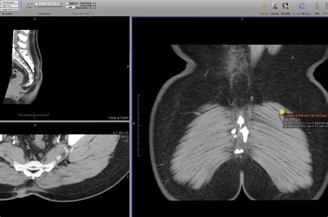 Imaging Studies For Preoperative Planning Of Perforator Flaps Clinics