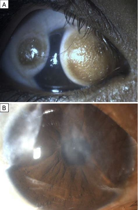 Double Limbal Dermoid With Tessiers Paramedian Facial Cleft Journal