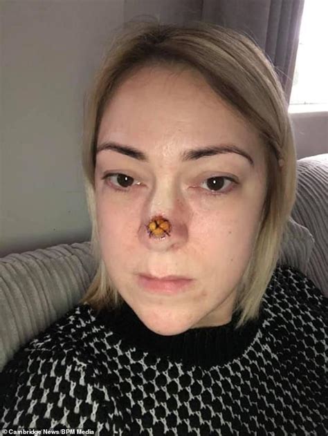 Mother Found The Spot On The End Of Her Nose Was Actually Cancer