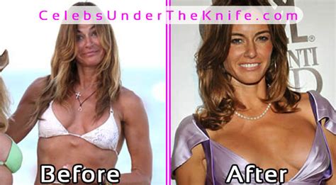 Bad Breast Implants Gone Wrong Before And After Photos