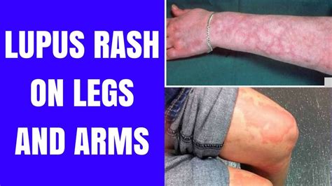 Lupus Rashes On Legs