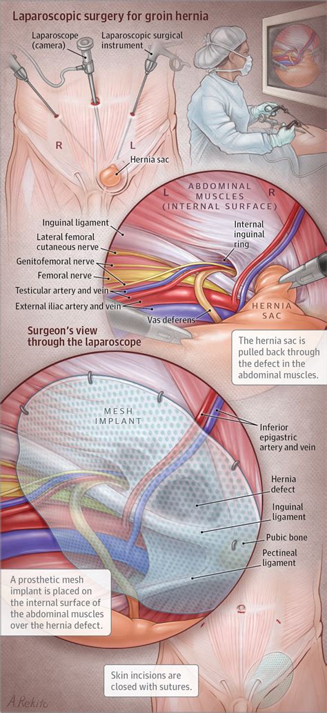 Hernia mesh, also known as surgical mesh, supports damaged muscles around hernias. Laparoscopic Groin Hernia Repair | Minimally Invasive Surgery | JAMA | JAMA Network