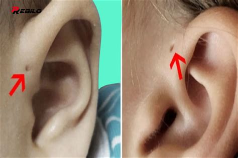 If You Have A Small Hole Above Your Ear Here’s What It Means