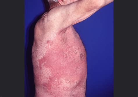 Update On Efficacy Of Treatments For Cutaneous Candidiasis Dermatology Advisor