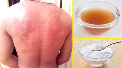 How To Get Rid Of Hives At Home With Natural Home Remedies Youtube