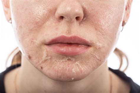 Scaly Skin After Chemical Peel Causes And Remedies Typeost