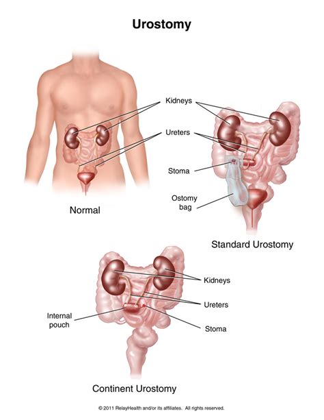 Urostomy Stoma Care Causes Symptoms Treatment