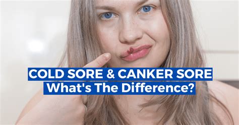 Cold Sore Vs Canker Sore What Are The Differences