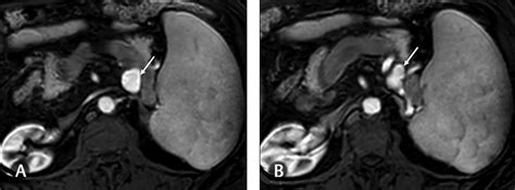 Axial T1 Weighted Fat Suppressed Postcontrast Arterial Phase Images