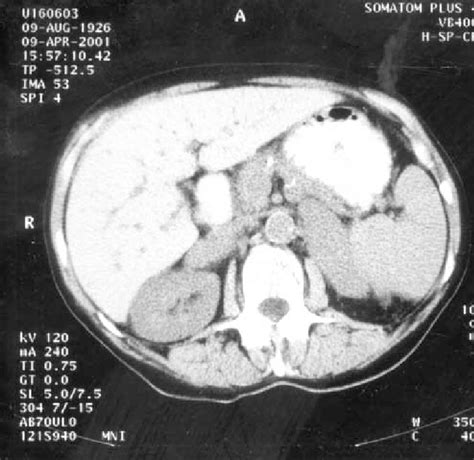 Ct Scan Of Abdomen Showing Enlargement Of Both Adrenal Glands