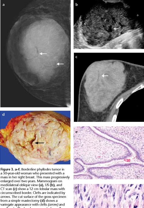 Figure 3 From Fibroadenoma Versus Phyllodes Tumor Distinguishing