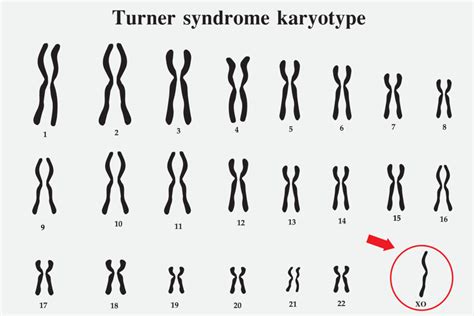 Síndrome de Turner monossomia X características cariótipo e causas