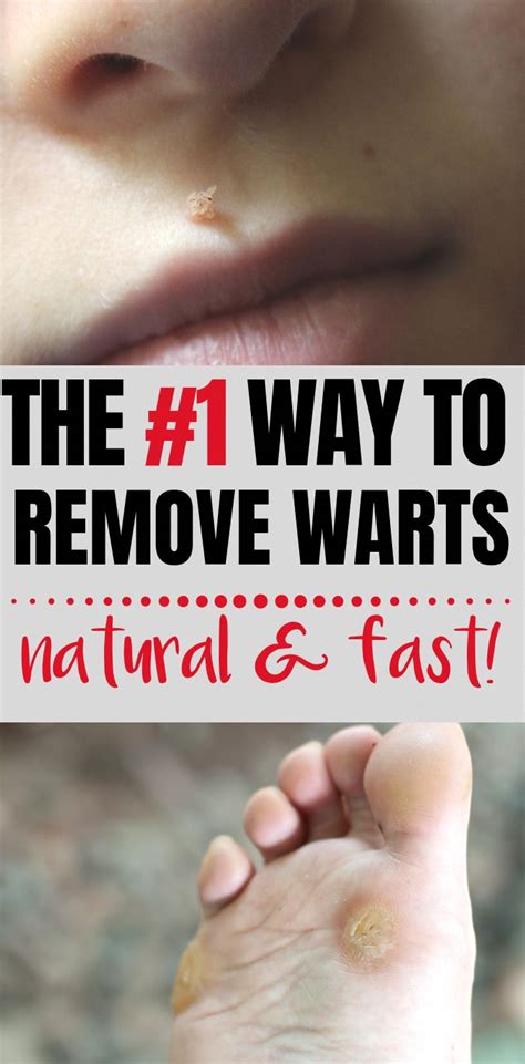 Natural Remedies Get Rid Of Warts Naturally With This Simple Trick