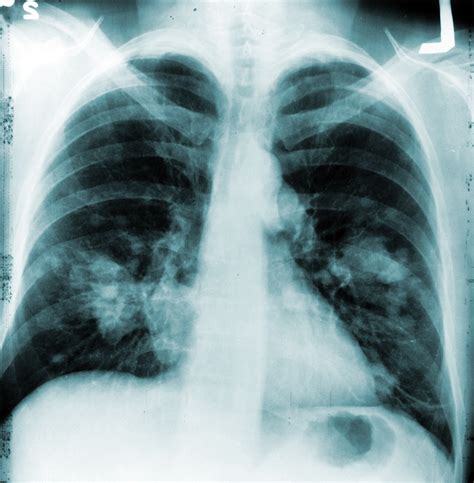 Chest X Ray Nodules Lung Cancer Chest Ray Rays Deaths Nih Annual Cut