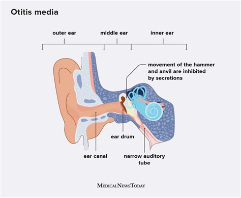 Otitis Media Symptoms And Causes Of Middle Ear Infection