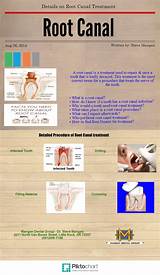 Photos of Root Canal Treatment Procedure Pictures