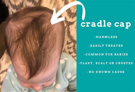 Cradle Cap What It Is Where Does It Occur How Do You Treat It