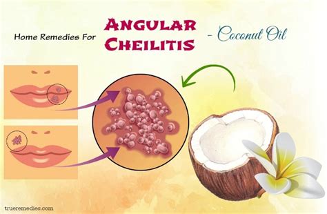 25 Natural Home Remedies For Angular Cheilitis Infection Fast