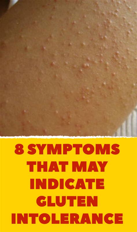 Some people may develop a severe allergic reaction (anaphylaxis), which can be life threatening. 8 symptoms that may indicate gluten intolerance | Gluten ...