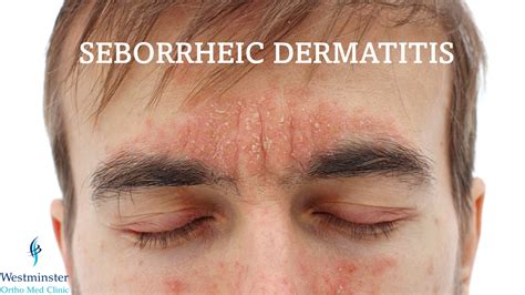 Seborrheic Dermatitis Dubai Healthcare City Westminster Ortho Med