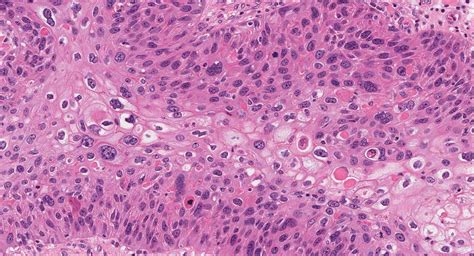What Is Squamous Cell Carcinoma Mypathologyreportca