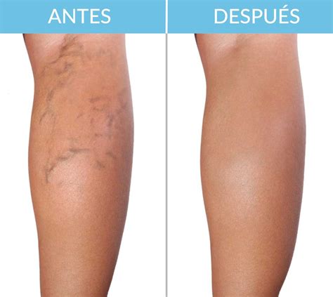 Varices Piernasantes Y Despues Sociedad Española De Radiología