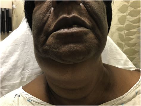 Adult Woman With Submandibular Neck Swelling Journal Of Emergency
