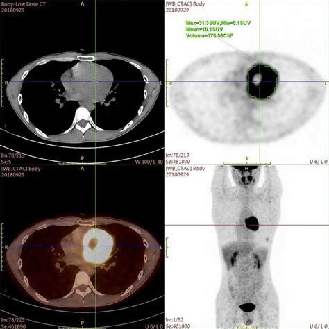 Positron Emission Tomography Computed Tomographic Scan Demonstrated A