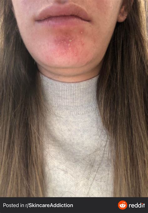 Routine Help Heres A Before And After On My Journey With Perioral