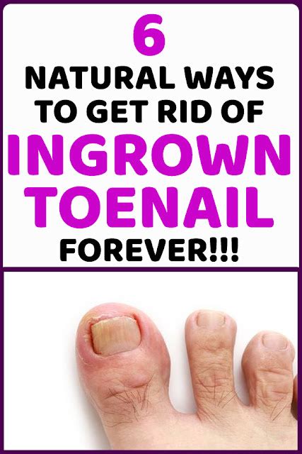Treat Your Ingrown Toenail With These 6 Natural And Homemade Remedies