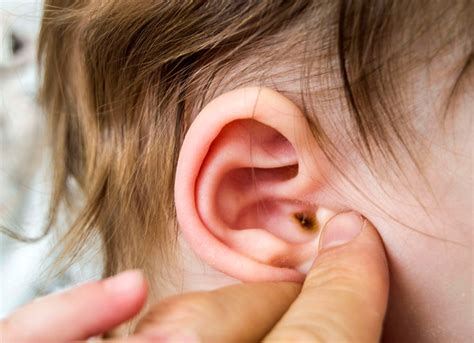 Todo Lo Que Tienes Que Saber Sobre La Otitis Club Familias