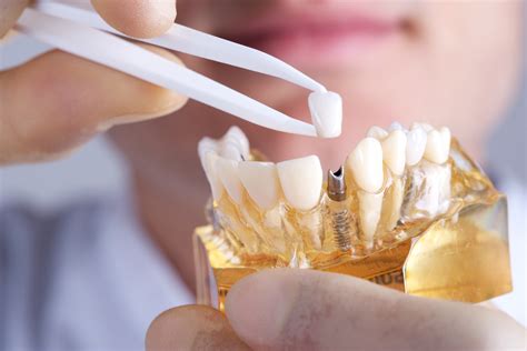 Types of Dental Implants - Brighton Implant Clinic : Dental Implants