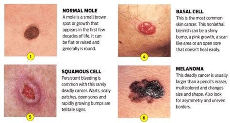 Warning Signs And Symptoms Of Non Melanoma Skin Cancer Page 6