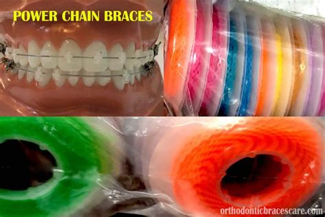 Power Chain Braces 101 Types Colors When Do You Get Orthodontic Braces Care