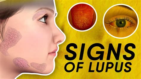 11 Signs Of Lupus You Should Not Ignore Youtube