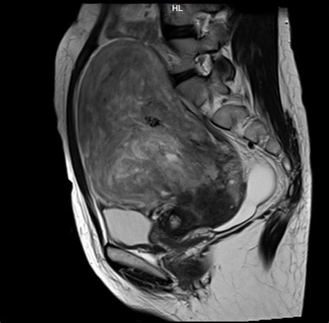 41 Before And After Uterine Fibroids Mri