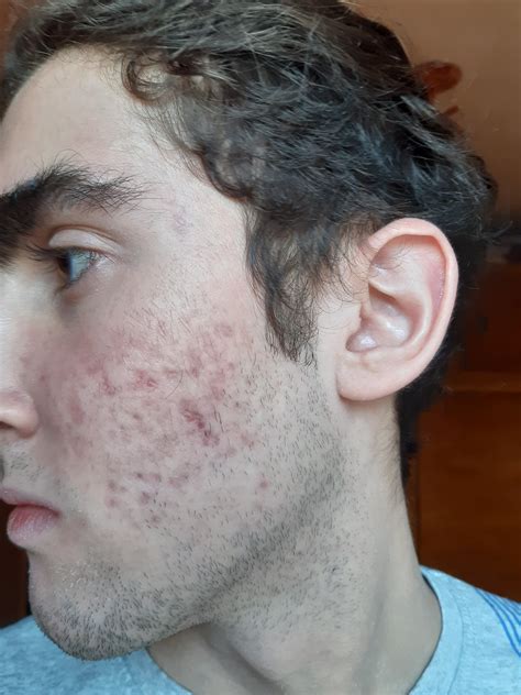 Cystic Acne Scars
