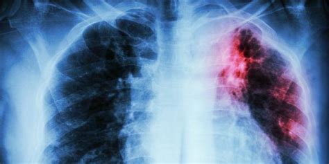 Tuberculose do Pulmão ou Tuberculose Pulmonar Causas Sintomas Tipos Tratamento