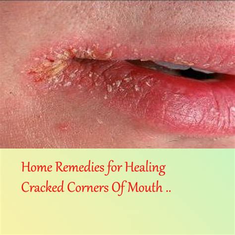 Cracked Corners Of Mouth Treatment Online Elixir