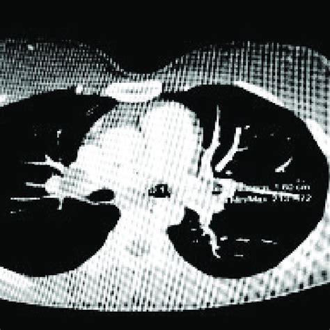 Chest X Ray Before Operation Showing Right Hilar Mass Red Arrow Mark
