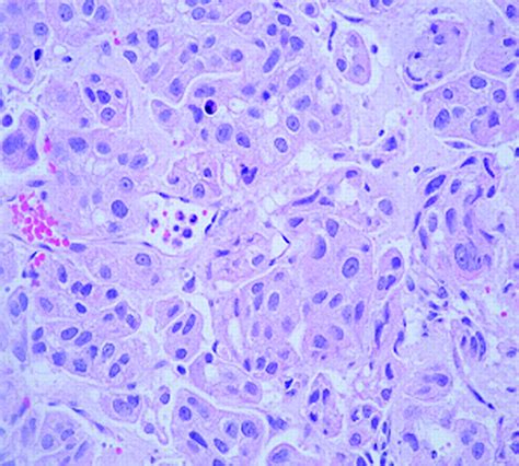 Herpetiform Cutaneous Metastases From Transitional Cell Carcinoma Of