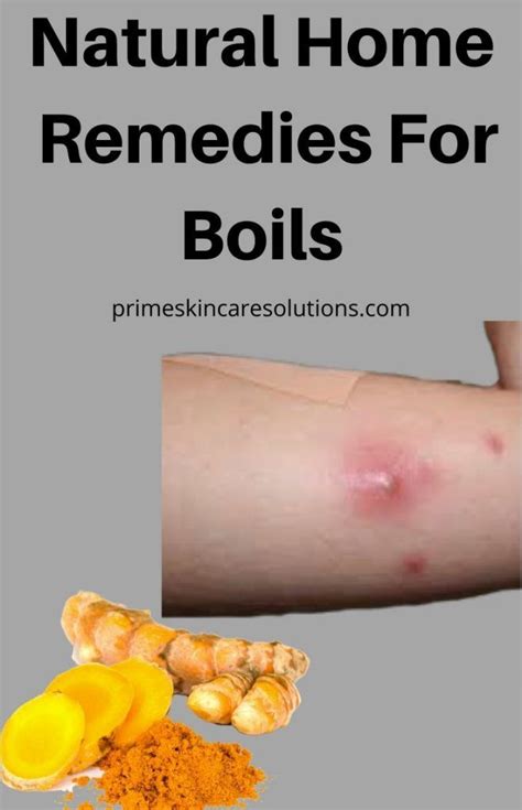 Natural Home Remedies For Boils Home Remedy For Boils Natural Home Remedies Home Remedies