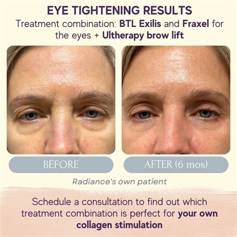 Skin Tightening Radiance Skincare And Laser Medspa Wheaton Il