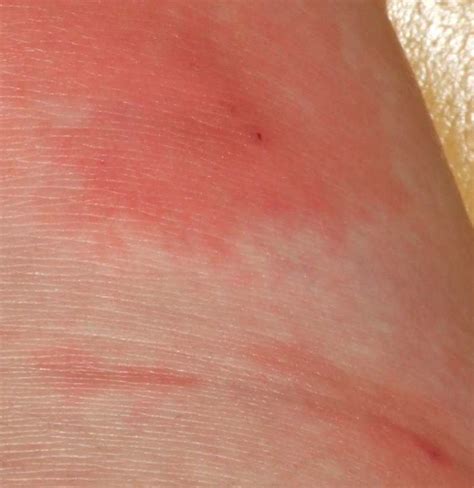 Skin Infection Pictures And Treatments