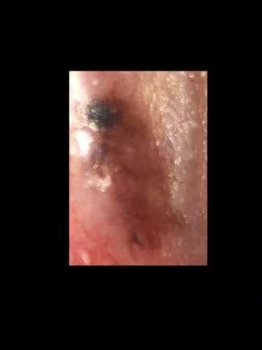 What Does Skin Cancer Of The Vulva Look Like
