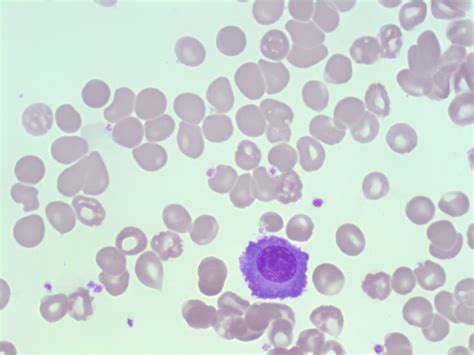 Plasma Cells A Laboratory Guide To Clinical Hematology